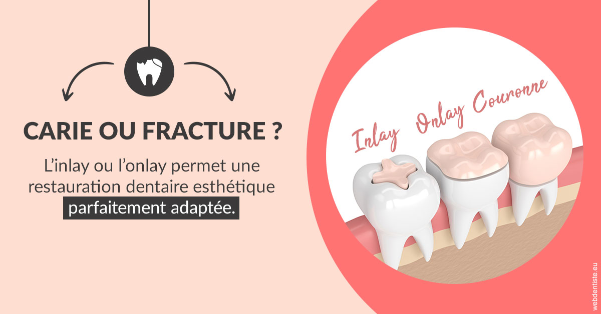https://dr-do-thi-thuy-thao.chirurgiens-dentistes.fr/T2 2023 - Carie ou fracture 2