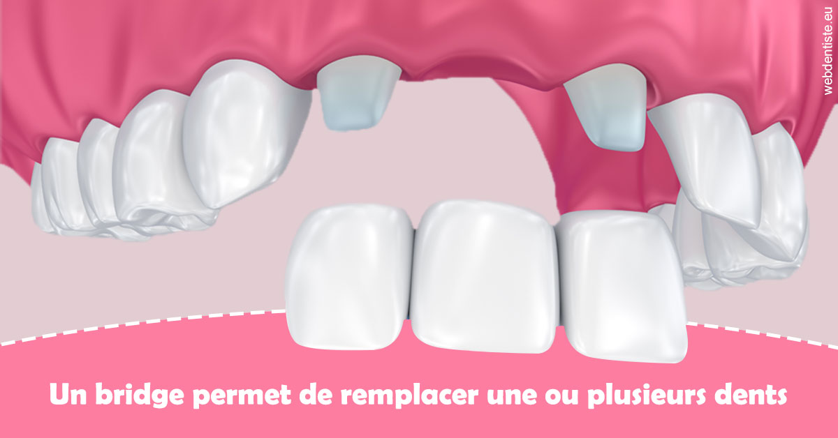https://dr-do-thi-thuy-thao.chirurgiens-dentistes.fr/Bridge remplacer dents 2