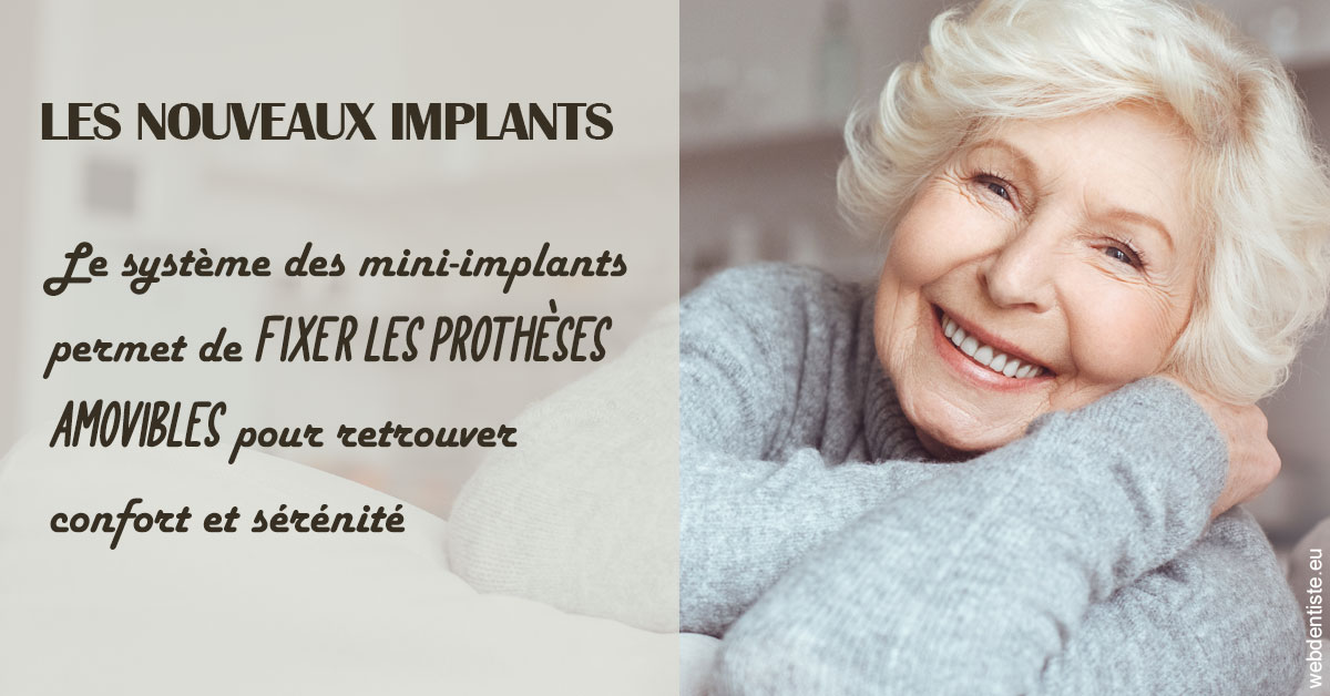 https://dr-do-thi-thuy-thao.chirurgiens-dentistes.fr/Les nouveaux implants 1