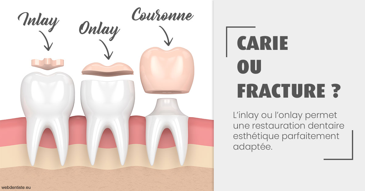 https://dr-do-thi-thuy-thao.chirurgiens-dentistes.fr/T2 2023 - Carie ou fracture 1