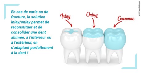 https://dr-do-thi-thuy-thao.chirurgiens-dentistes.fr/L'INLAY ou l'ONLAY