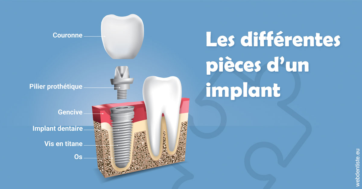 https://dr-do-thi-thuy-thao.chirurgiens-dentistes.fr/Les différentes pièces d’un implant 1